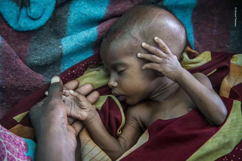 Infant suffering from malnutrition in Niger