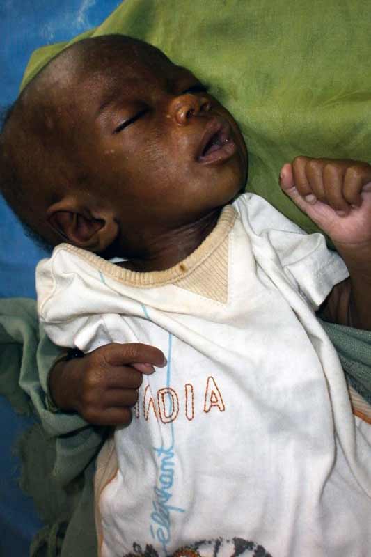 Infant before being treated for malnutrition