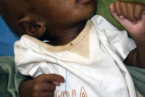 Infant before being treated for malnutrition