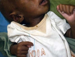 Infant before being treated for malnutrition